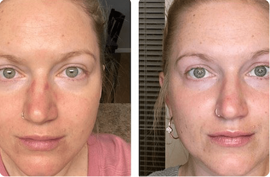 Luminous Laser Offers Microneedling in Scottsdale AZ 85260